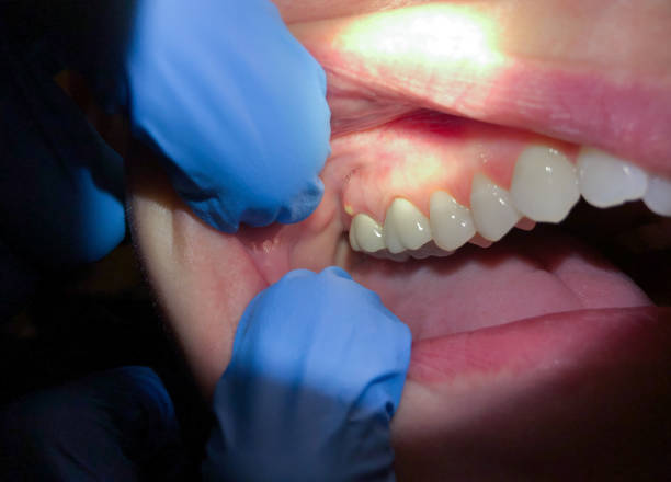 Best Emergency Wisdom Tooth Extraction in Trainer, PA
