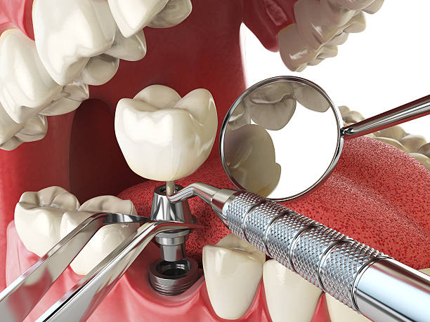 Best Knocked-Out Tooth (Avulsed Tooth) Treatment in Trainer, PA